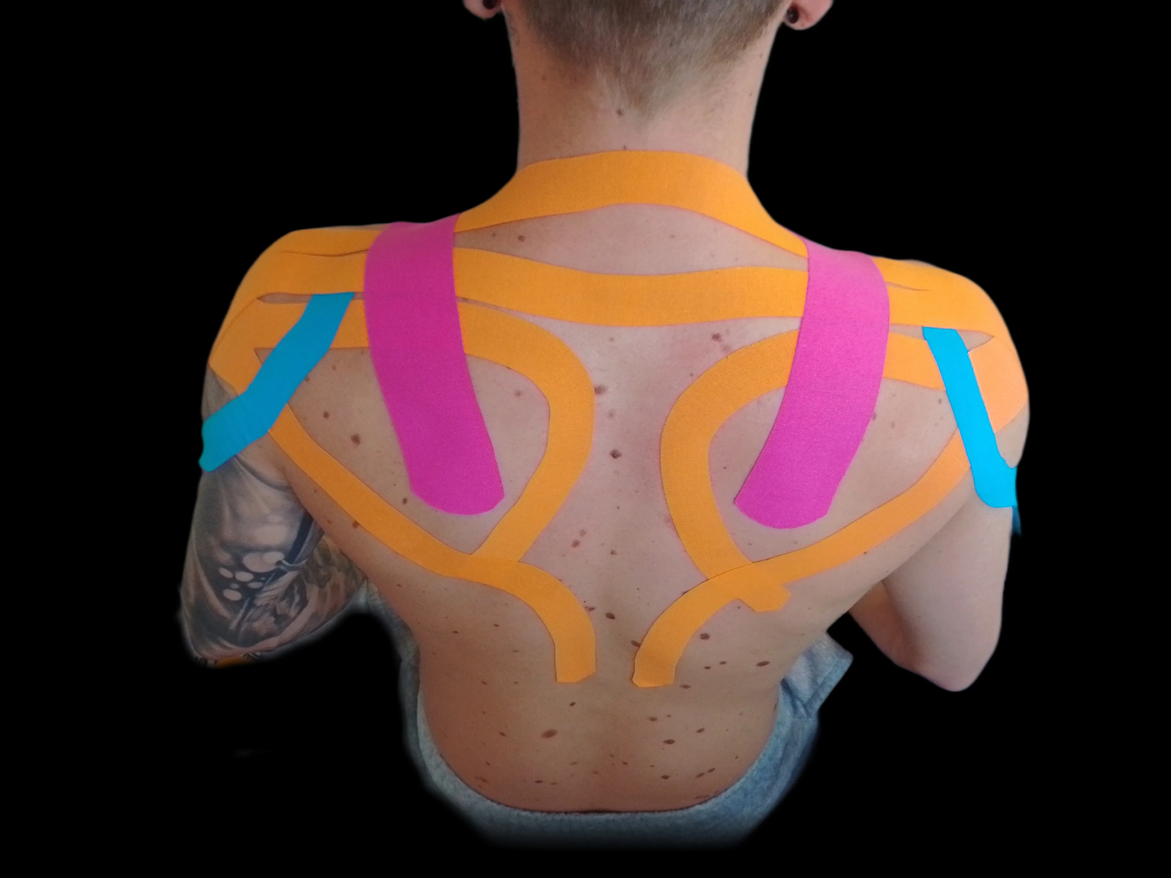 Kinesio-Tapes auf Schulter und oberem Rücken